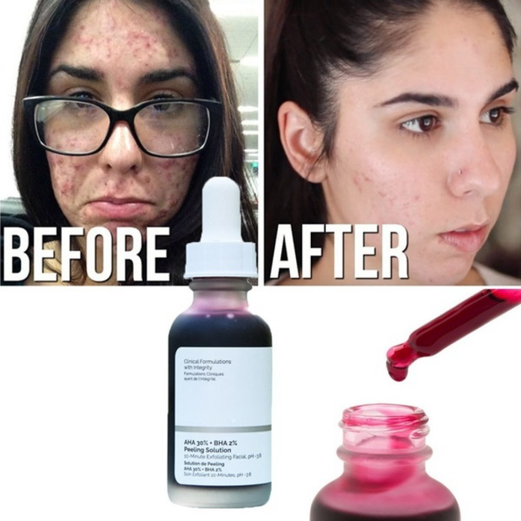 -The Ordinary- Peel Da Tẩy Da chết Hoá Học Thanh Tẩy Da Aha 30 - 2peeling